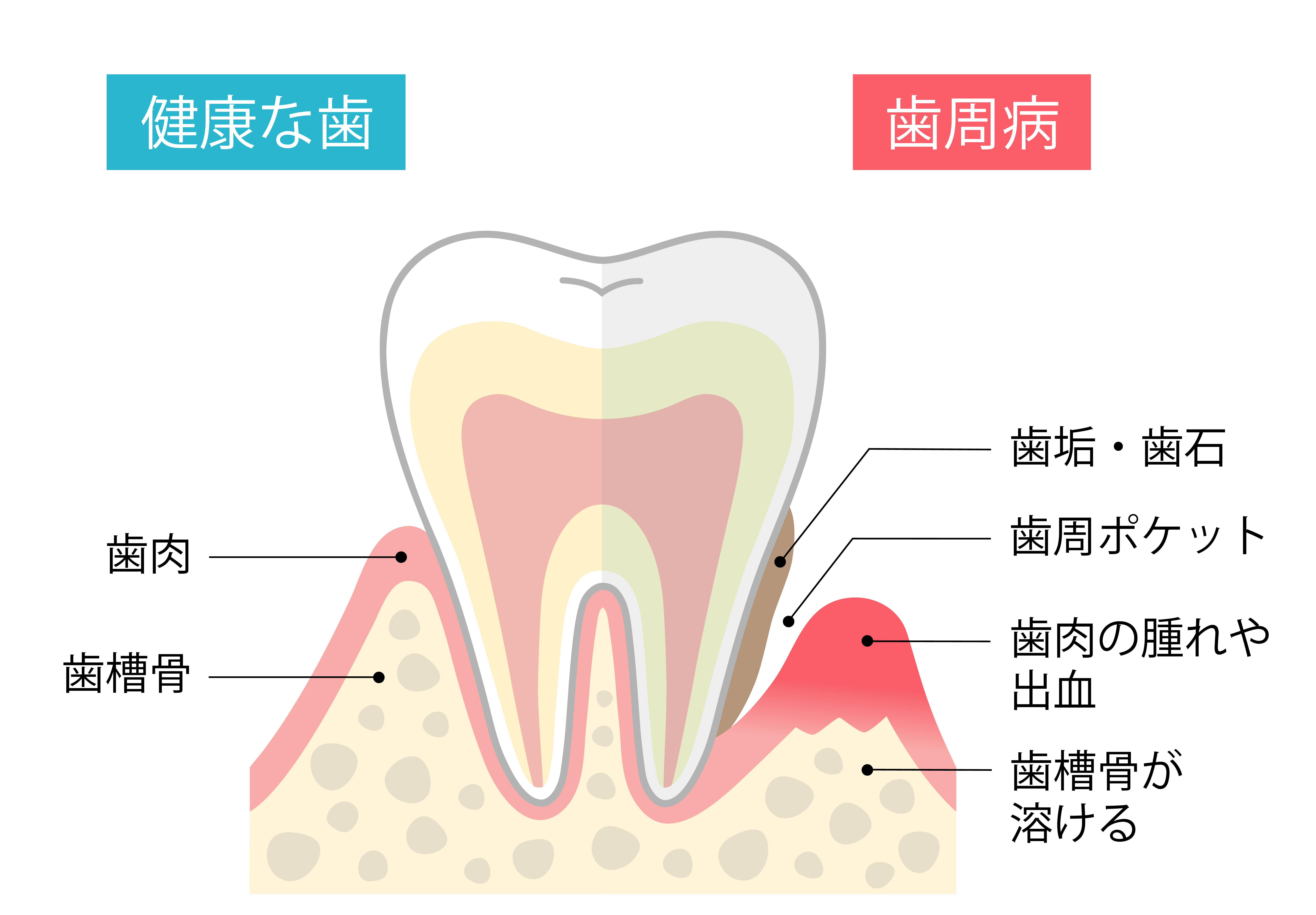 歯ぐきが下がってきたらどうする？考えられる原因と対処法を解説