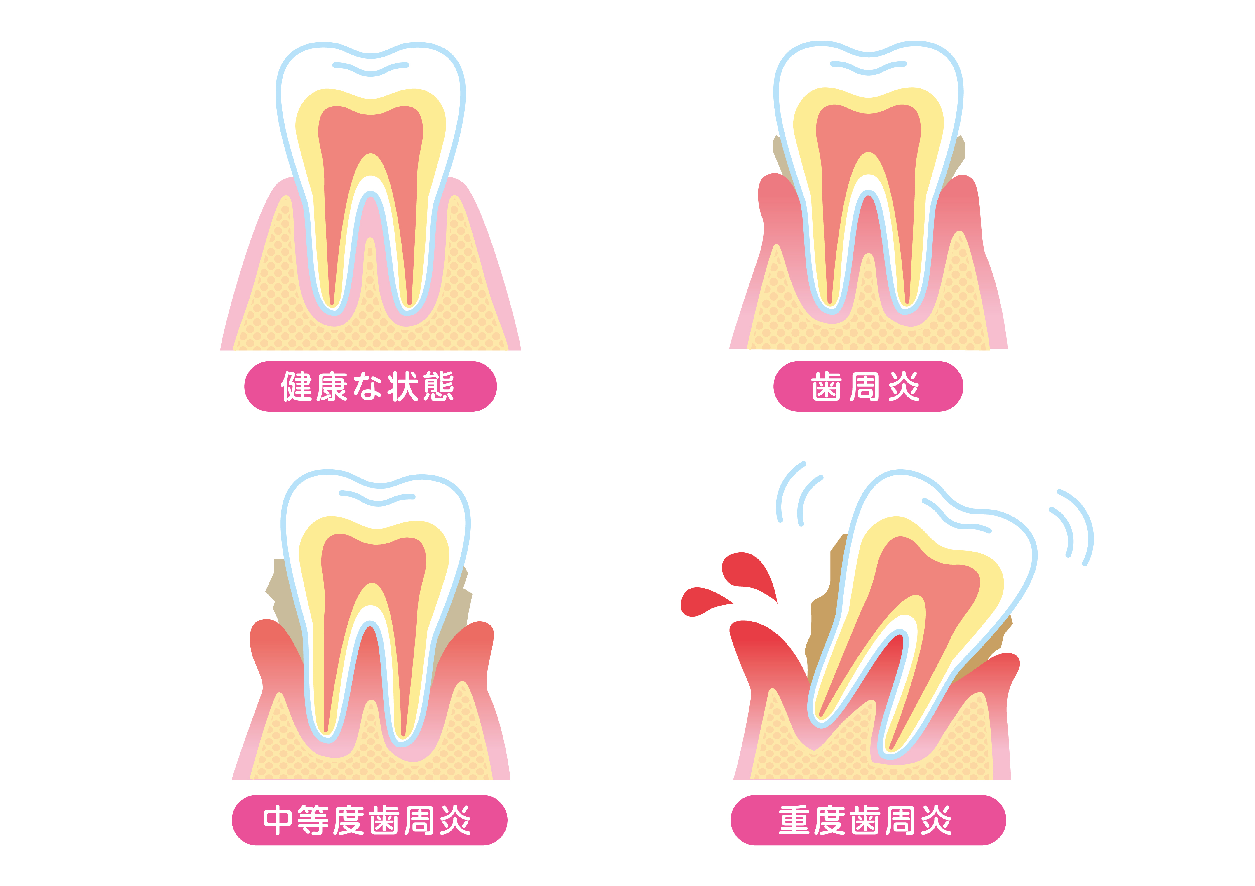 インプラントを検討中の方が治療前に歯周病のチェックが大切な理由とは?