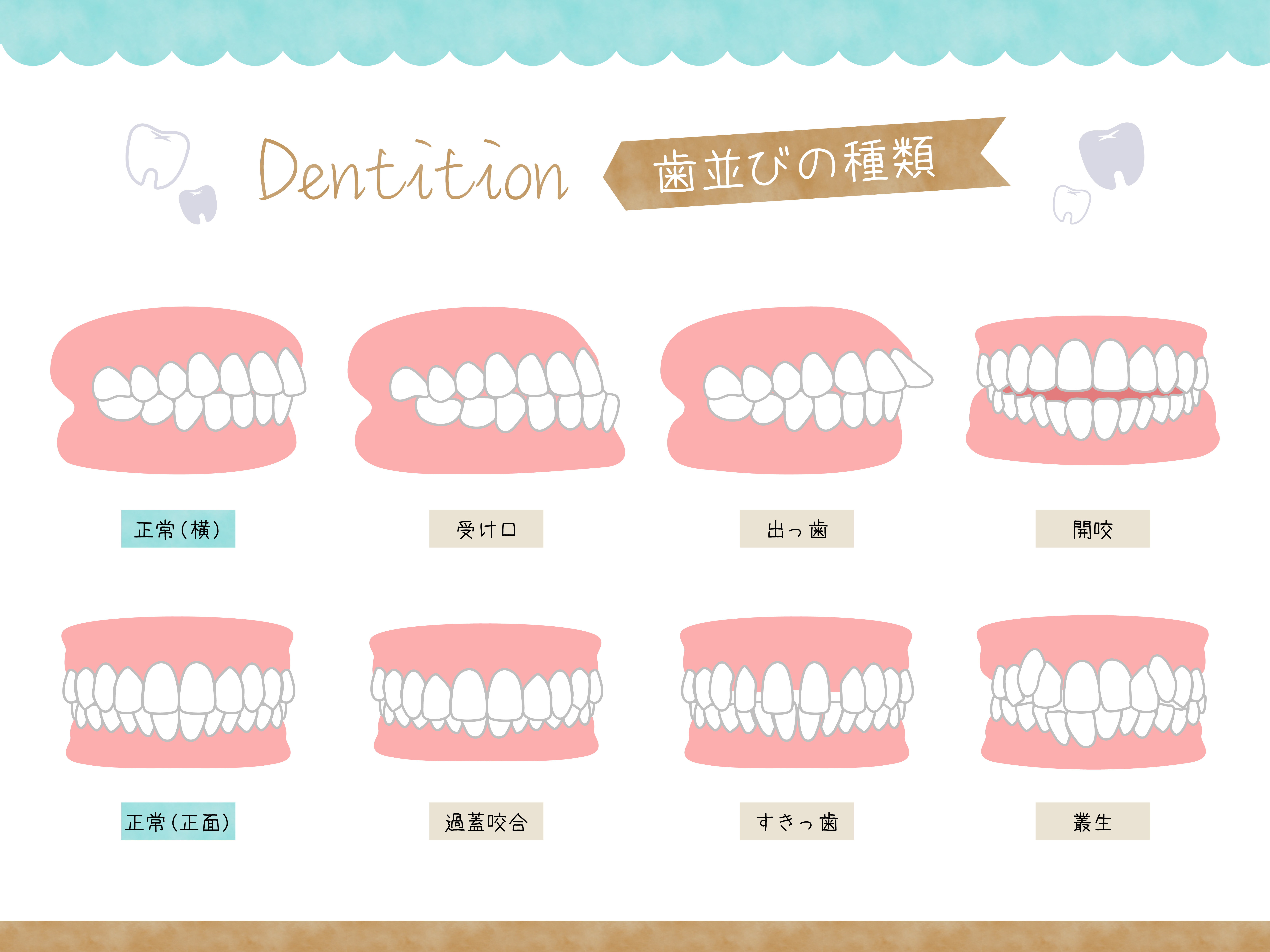 マウスピースでできるお子様の受け口治療 　 パナシールドのご紹介