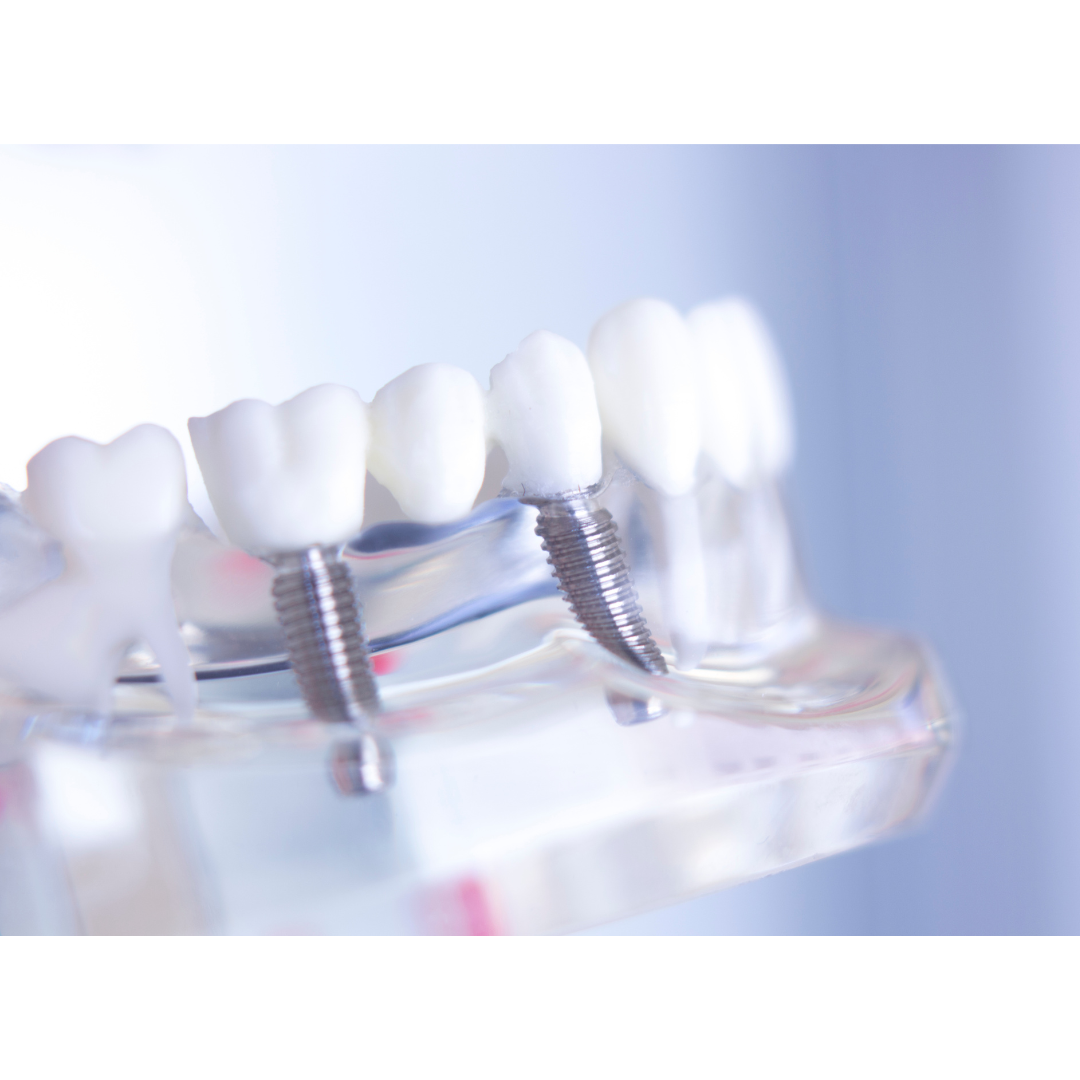 インプラント治療は糖尿病でも大丈夫?リスクと対策をわかりやすく解説