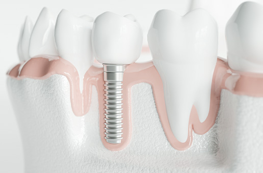 誰でもできる?インプラントが向いている人・向いていない人とは