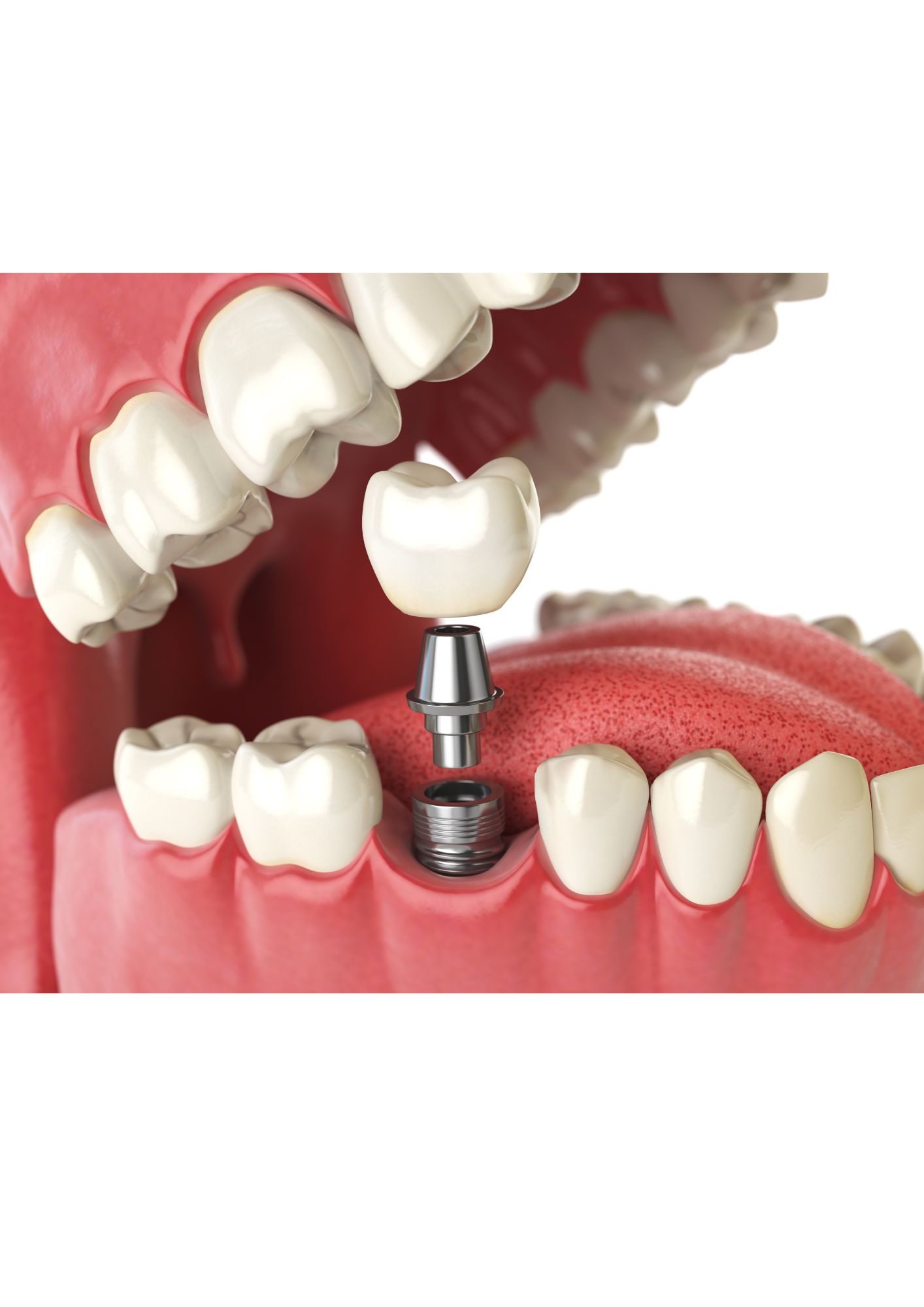 インプラントで10年後に差がつく理由とは？長持ちする人の共通点