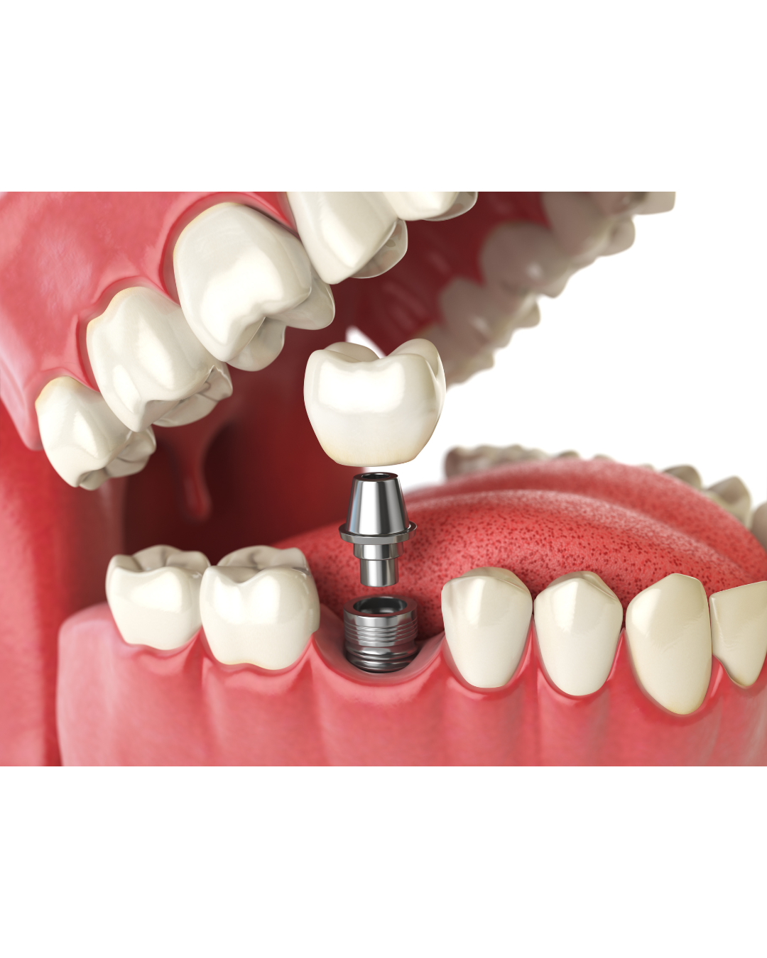 インプラントの保証制度って必要？後悔しないために知っておきたいポイント