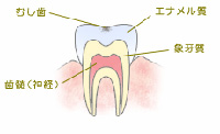 C0：ごく初期の虫歯