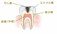 C2：象牙質の虫歯