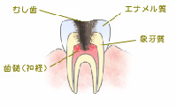 C3：神経にまで達した虫歯