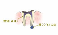 C4：歯根にまで達した虫歯